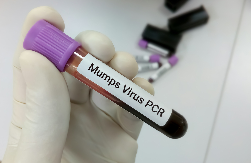 Mumps outbreak declared by NICD